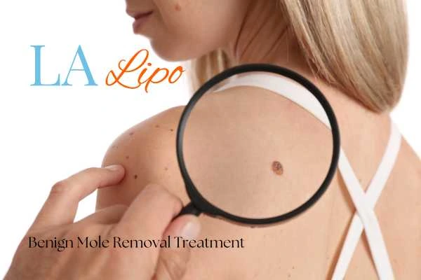 Why getting moles removed Leigh-on-Sea can boost your confidence!