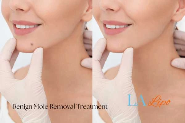 Woman's before and after results of being moles removal treatment Leigh-on-Sea
