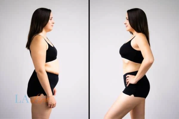 image of woman before and after results of LA-EMS Body Sculpting Leigh-on-Sea to help treat Diastasis recti