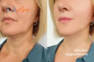 hi-fu for wrinkles Leigh-on-Sea before and after results