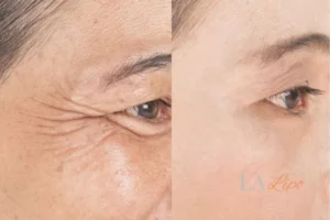 Before and after results of woman - HI-fu wrinkles reduction treatment Leigh-on-Sea