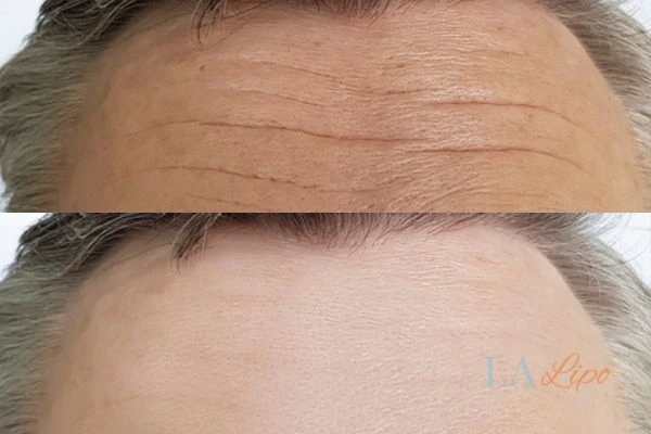 results of HIFU Leigh-on-Sea on mans forehead to help reduce lines and wrinkles