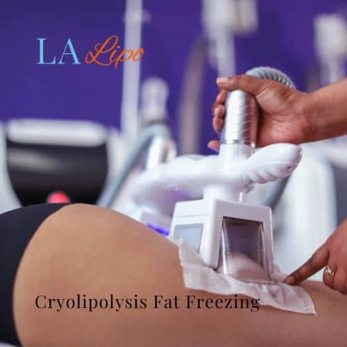fat freezing - Cryolipolysis Leigh-on-Sea