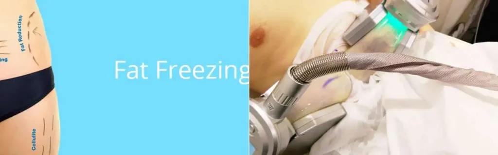 Fat freezing Leigh-on-Sea on multiple areas of the body