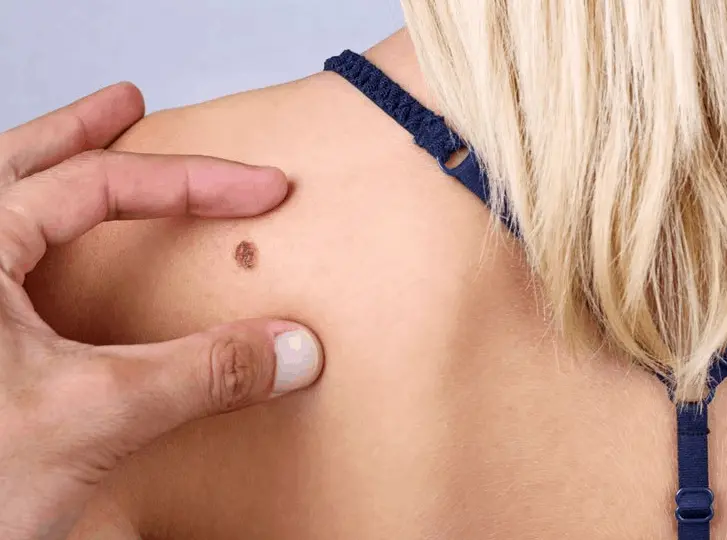 woman having mole removal Leigh-on-Sea consultation before treatment.