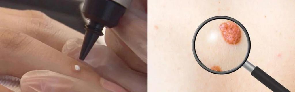 Person getting moles removed with cryopen Leigh-on-Sea