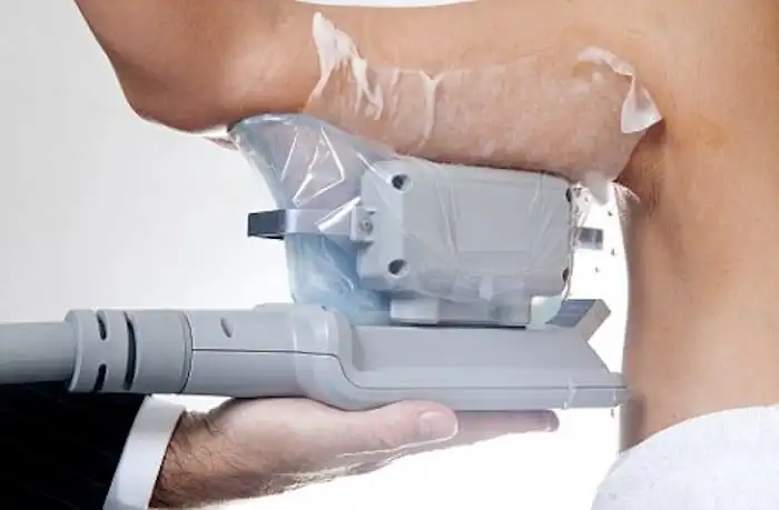 Picture of fat freezing Leigh-on-Sea on the upper arms.