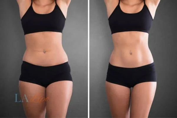before and after results of non-surgical treatment to help a woman's body image and mental health Leigh-on-Sea