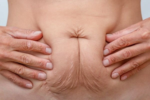 Image of a woman's stomach with loose skin - example of skin tightening Leigh-on-Sea options